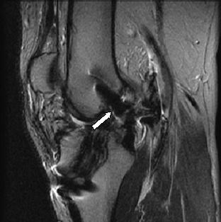 Fig. 11- Sagital T2W (TE:70 TR:2100). Protusão intercondiliana do parafuso femural (seta) num doente de 24 anos com instabilidade articular.