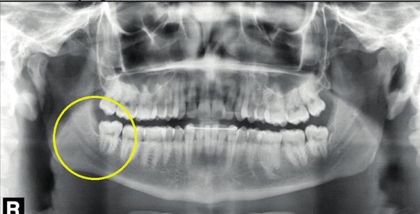 Na mandíbula existe a preocupação com a lesão ao feixe vásculo nervoso alveolar inferior (nervo, artéria e veia homônimos); os exames radiográficos permitem a