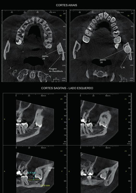 Notar a posição ectópica do dente 38 (posicionado em bordo anterior do ramo da mandíbula, mantendo