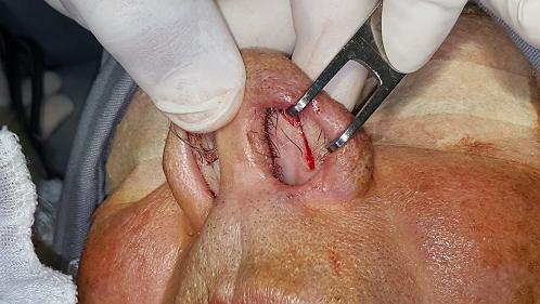 Foi iniciado com uma incisão transfixante e uma incisão intercartilaginosa bilateral, e uma incisão sublabial realizada do molar até o