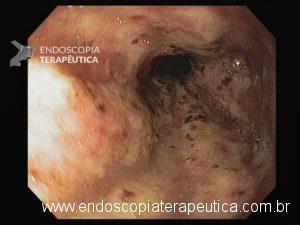 Esôfago distal TEG INTRODUÇÃO A necrose esofágica aguda (NEA), também conhecida como esôfago negro ou esofagite necrotizante, é uma síndrome rara caracterizada por uma aparência escurecida