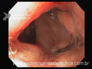 normal). EPIDEMIOLOGIA A necrose esofágica aguda é uma condição rara com uma prevalência estimada de até 0,2 % em séries de autópsia.
