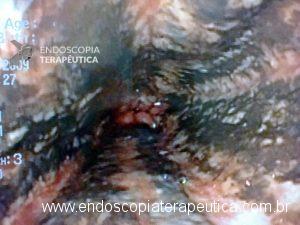 É mais comumente observada no esôfago distal. Em contraste com a necrose esofágica aguda, a descoloração é frequentemente focal.
