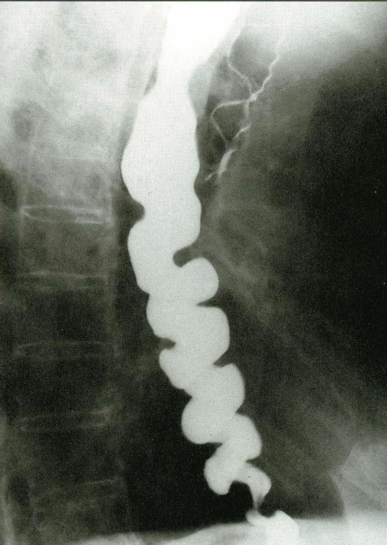 DIAGNÓSTICO Radioscopia baritada do esôfago: esôfago em saca-rolhas ( corkscrew ).