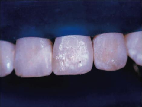 DENTÁRIOS FOTOGRAFIA 15 - COLOCAÇÃO