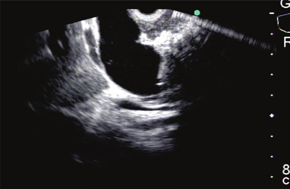 frequentemente acessado devido a sua melhor visualização, especialmente quando o stent deverá ser locado cárdia ou na pequena curvatura 26,31,32.