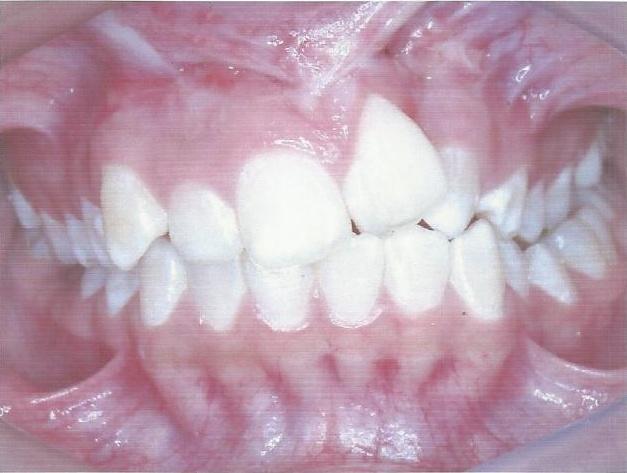 FIG.2 : Intrabucal frontal A B FIG.