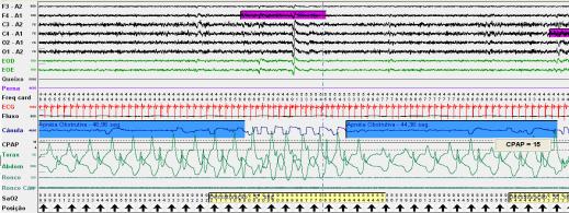 SCA, 65 anos, IMC: 26,1 Kg/m 2. SAOS grave + HAS + FA crônica. Sonolência diurna apesar de uso adequado de CPAP As 23h.