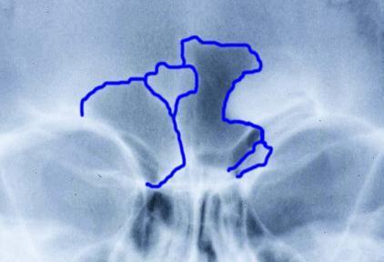Com relação aos seios frontais por apresentarem várias particularidades anatômicas, são muito utilizados no processo de identificação através de radiografias ante-mortem e postmortem, por serem