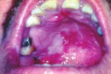 Neto et al, Candidíase bucal em qualquer idade, mas especialmente, quando se encontram debilitadas ou portadoras de doenças crônicas, ou ainda, em lactentes.
