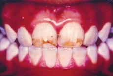 Zenkner et al, Fluorese dental Baratieri et al., 2001), sendo este um método conservador, pois consiste na remoção da camada superficial do esmalte fluorótico (Arneberg, Sampaio, 2000).