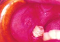 Oliveira et al, A Paracoccidioidomicose na odontologia lesões úlcero-granulomatosas em mucosa bucal.