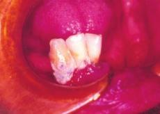 Notavam-se a péssima condição de higiene oral, placa bacteriana e cálculo dentário na coroa dos dentes. Figura 1 Lesões ulcerada em mucosa jugal.