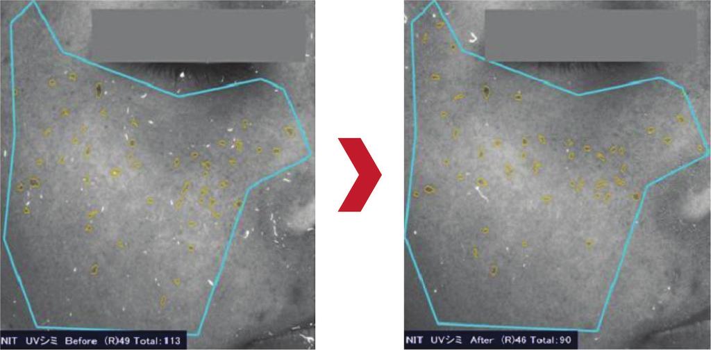 PREVINE E COMBATE AS MANCHAS CAUSADAS PELA RADIAÇÃO UV LumineCense INN inibiu em 2% as manchas causadas pela radiação UV em apenas 3 dias