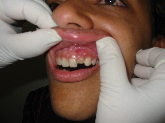 As perdas dentárias sempre decorrem prejuízo às vítimas, não sendo admissível a