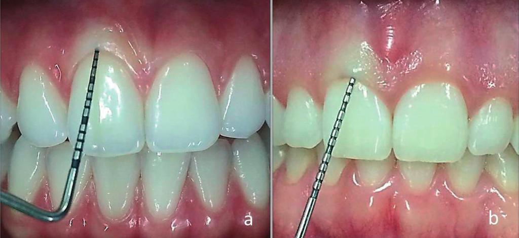 e freios altos Trott & Love (1966), e (iv) fatores iatrogênicos relacionados aos procedimentos restauradores e periodontais (Gorman, 1967; Lindhe & Nyman, 1980; Valderhaug, 1980).