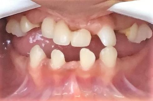 determinadas de acordo com a quantidade de dentes envolvidos em hipodontia, oligodontia e anodontia. Considera-se hipodontia quando há ausência de menos de 6 dentes permanentes.