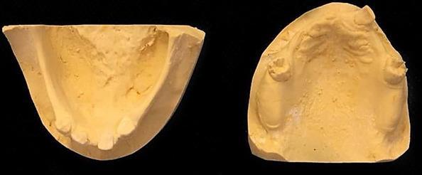 Inicialmente foi realizada uma moldagem de estudo superior e inferior com moldeira de estoque (TECNO- DENT) e alginato tipo II (Jeltrate Dustless Dentsply), e obtenção dos modelos de estudo em gesso