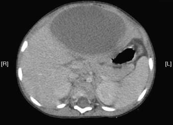 Figura 2. Tomografia computorizada com contraste, mostra lesão única no lobo hepático esquerdo de 9,5 x 8 x 6,2 cm (corte axial). Figura 1.