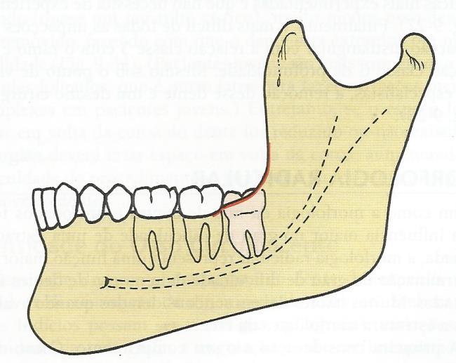 Fig. 9: Impactação classe B. Classe C quando a face mais alta do terceiro molar estiver localizada abaixo da linha cervical do segundo molar (figura: 10). (4,5,6) Fig. 10: Impactação classe C.