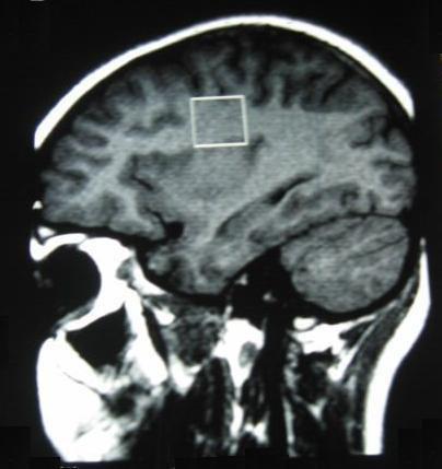 Ressonância nuclear magnética com espectroscopia de prótons Paciente 1: MM N-acetilaspartato (NAA): reduzido nos processos neurodegenerativos; Colina: aumentada nos processos