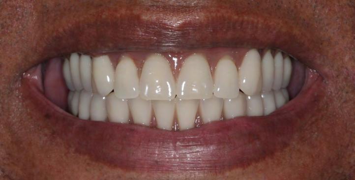 Reabilitação total maxilo-mandibular em paciente portador de doença periodontal generalizada AUTOR: Prof. Dr. Renato Savi de Carvalho.