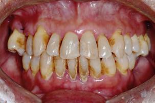 Ao exame clínico e de imagem se observou doença periodontal generalizada em estágio avançado, com comprometimento de todos os dentes de ambas as arcadas - exceção feita ao elementos 44 e 45 que não