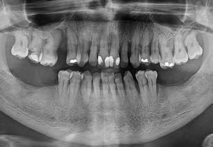 Este padrão de perda óssea é comum em pacientes periodontopatas e, rotineiramente, impossibilita a instalação de implantes em áreas posteriores da maxila, obrigando o CD a incliná-los para anterior