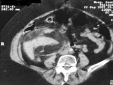 intratumoral, obriga a colocar a hipótese de carcinoma de células renais.