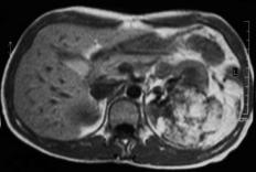 A RM permite a caracterização da maioria dos angiomiolipomas devido à deposição intratumoral de gordura, que surge hiperintensa em T1 e hipointensa em out phase e nas técnicas com supressão de