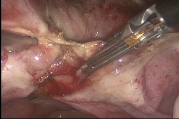 Histerectomia laparoscópica