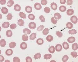 Equinócitos ou Hemácias crenadas: são artefatos da coleta ou armazenagem da amostra, nas quais as hemácias apresentam diversas espículas de tamanho aproximado e distribuídas simetricamente, assumindo