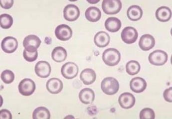 Eritrócitos fragmentados ou esquizócitos: Os eritrócitos podem se fragmentar formando formas anormais variadas, as causas dessa fragmentação podem ser trauma mecânico, agressão física ou química.