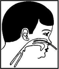Formas de administração 1) Cateter Nasal: Introduzido na cavidade nasal (distância = comprimento entre o nariz e o