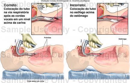 INTUBAÇÃO