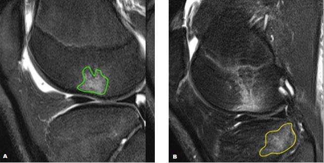 ligamentares na articulação, as zonas ósseas mais suscetíveis a sofrerem lesões de esforço são o côndilo femoral medial e o prato tibial medial (43).