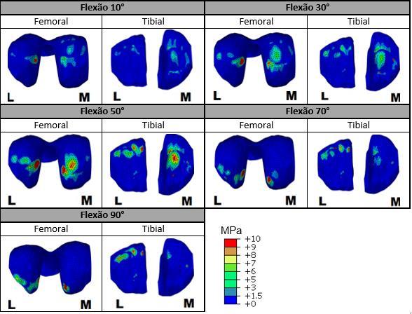 Tabela 5- Pressão máxima de contacto nas cartilagens femoral e tibiais ao longo do movimento de flexão do joelho para o modelo intacto (MPa).