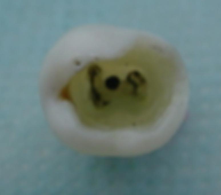 Estes dentes foram selados com cera utilidade e 2 camadas de esmalte incolor.