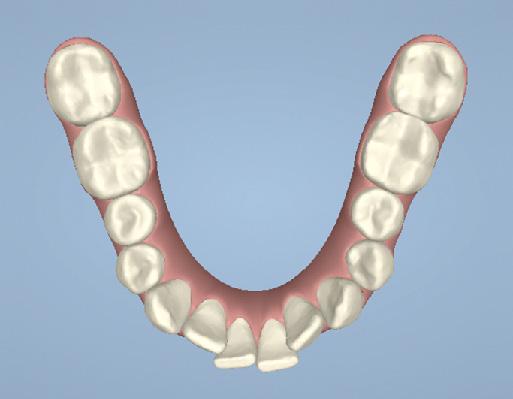 Existem três opções básicas para solução do apinhamento, são elas: vestibularização (inclinação da coroa para vestibular), expansão dental posterior (inclinação da coroa) e desgaste interproximal