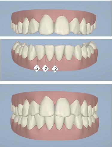 Apinhamento e inclinação de dentes.