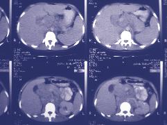 Caroni et al. PARACOCCIDIOIDOMICOSE JUVENIL 15 Após a alta foi indicado o uso de 100 mg de itraconazol oral até completar dois anos de tratamento.