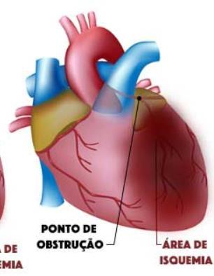 O que é choque cardiogênico?