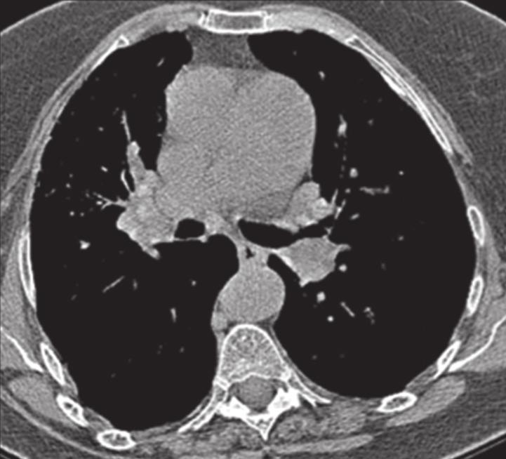 564 Figura 1 - Em a, TC de tórax; a janela tomográfica de mediastino mostra a presença de placas pleurais bilaterais, algumas calcificadas (setas).