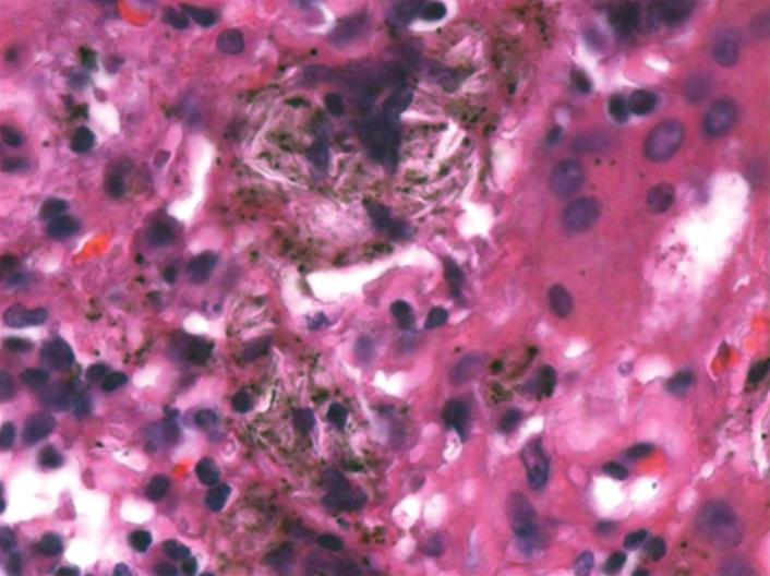 565 Figura 2 - Em a, reação gigantocelular à deposição de grande quantidade de partículas espiculadas birrefringentes, associadas a pigmento antracótico, no interstício pulmonar (H&E; aumento, 1.