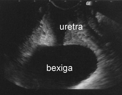 Quando é utilizada a via endovaginal, a bexiga deve estar vazia, para não afastar os órgãos pélvicos do transdutor.