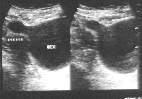 5. Formações diverticulares, que podem ser única ou múltiplas, que são visibilizadas como soluções de continuidade com a parede vesical quando o colo do divertículo é largo (são os