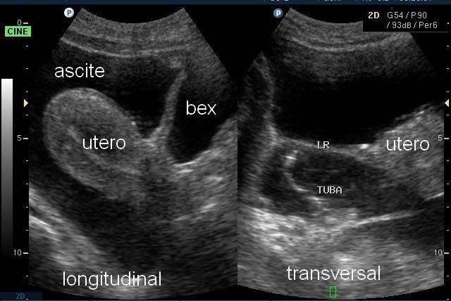 uterina), ou ser um espaço virtual (o reto é identificado imediatamente posterior ao útero). Eventualmente pode haver pequenas coleções líquidas fisiológicas como no período peri-ovulatório.