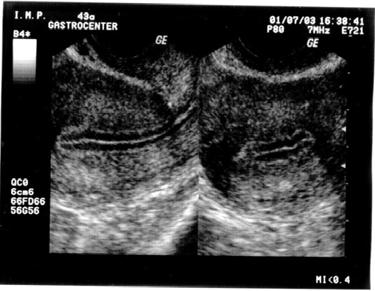 É importante ressaltar que a maioria das doenças endometriais são ecogênicas e um endométrio hipoecóico trilaminar típico visibilizado em toda a sua extensão é indicativo de normalidade, e afasta