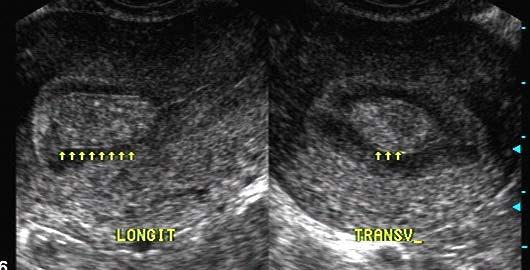 DOENÇAS ENDOMETRIAIS: Com exceção das patologias infecciosas, e algumas neoplasias mais raras (como os adenocarcinomas serosos e de células claras que podem originar-se do endométrio atrófico), as