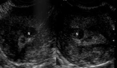 Pólipo endometrial em endométrio hipoecóico e mioma submucoso em endométrio ecogênico Hiperplasia endometrial: As hiperplasias endometriais apresentam-se hiperecogênicas e a textura ecográfica pode